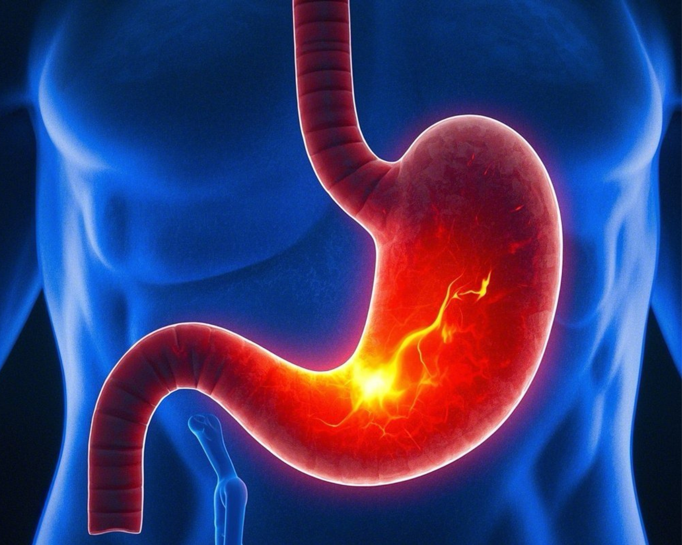 No momento, você está visualizando Azia: Entenda as Causas e Descubra Soluções Naturais para o Alívio